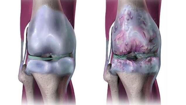 Здрав зглоб колена и погођен артрозом