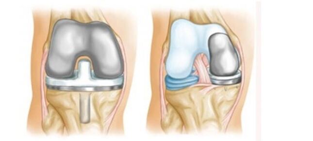 артропластика за артрозо коленског зглоба