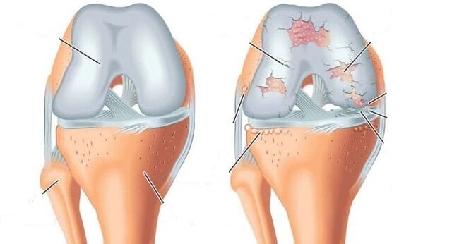 здрав зглоб и артроза коленског зглоба
