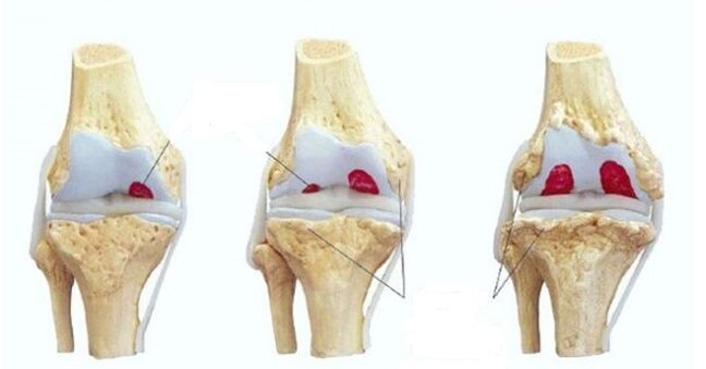 стадијуми артрозе коленског зглоба