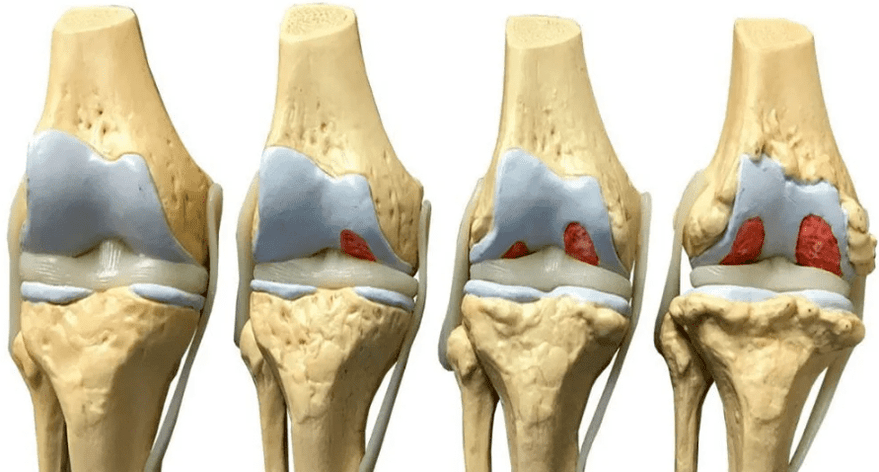 оштећење зглоба колена у различитим фазама развоја артрозе