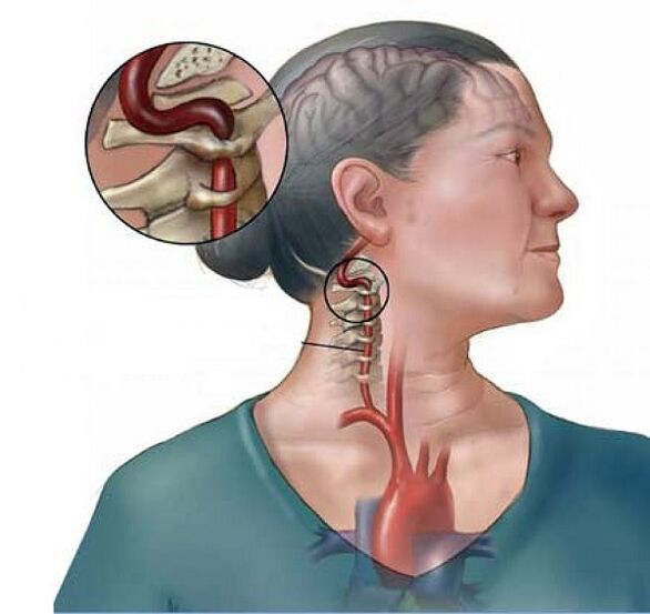 синдром вертебралне артерије са остеохондрозо грлића материце