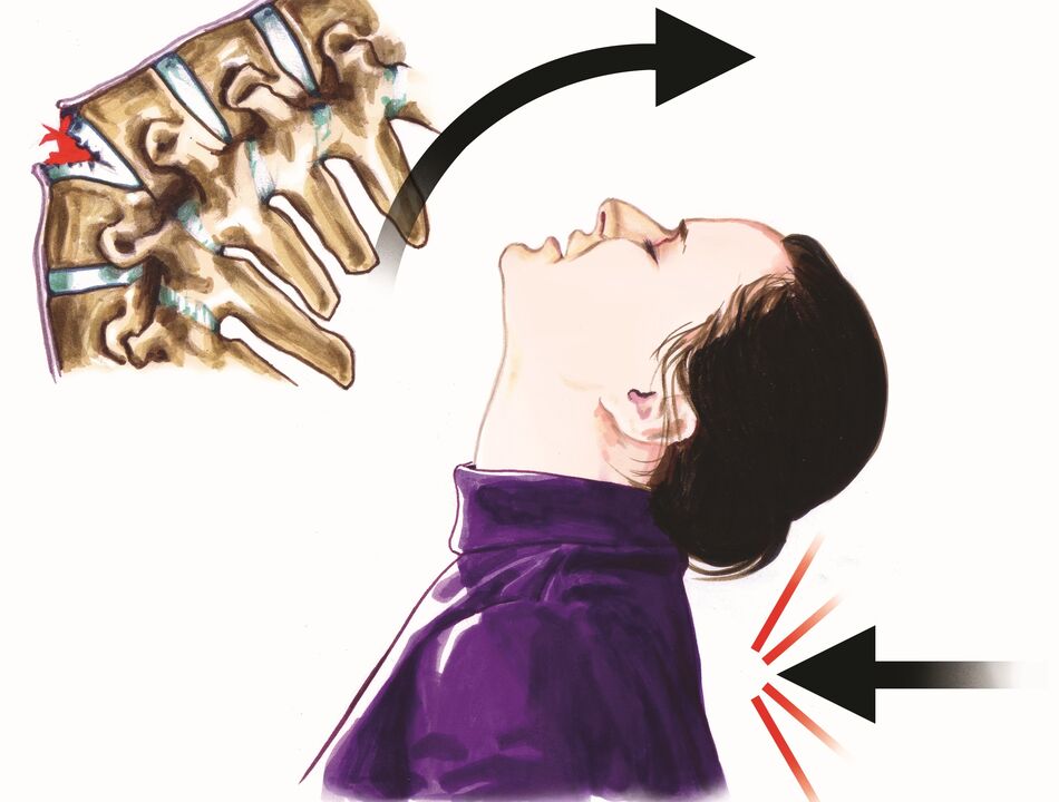 оштећење кичме као узрок бола у врату